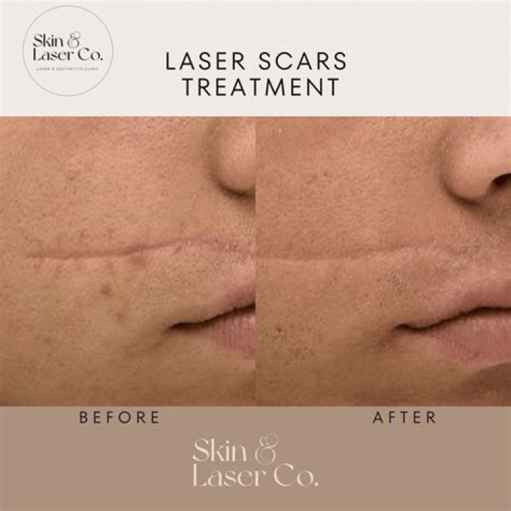 How Laser Treatments Helped Erase It – Hollywood Life