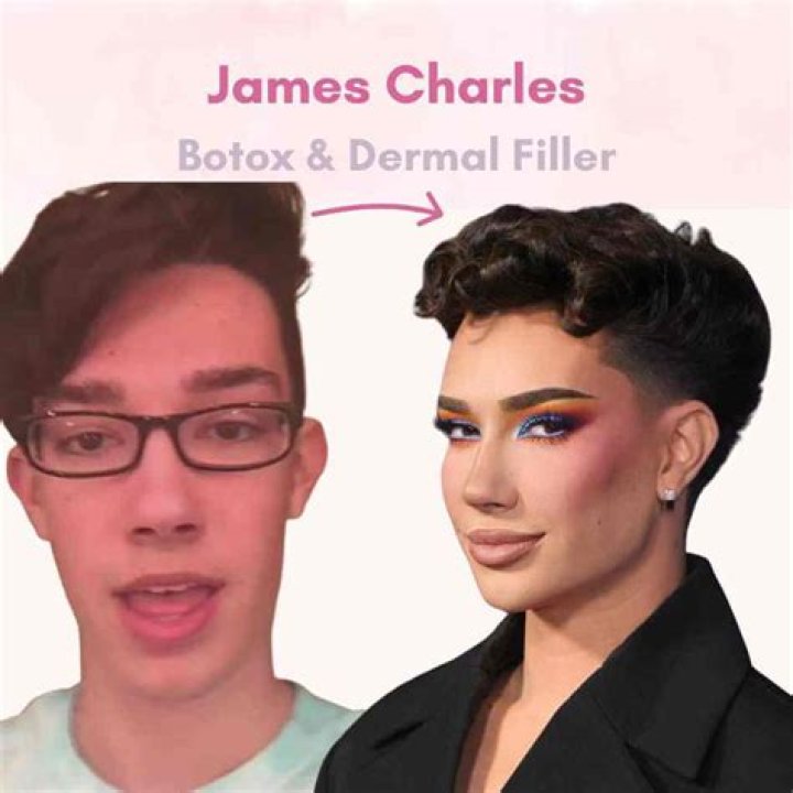 James Charles Admits To Lip Filler, Botox & More Plastic Surgery – Hollywood Life