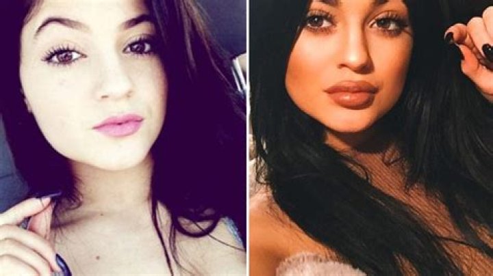 [PICS] Kylie Jenner Gets Lip Injections — Experts Speak Out – Hollywood Life