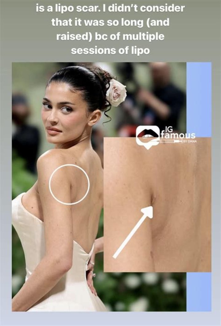 Kylie Jenner’s Red ‘Scar’ Worries Fans In Butt Revealing Instagram – Hollywood Life