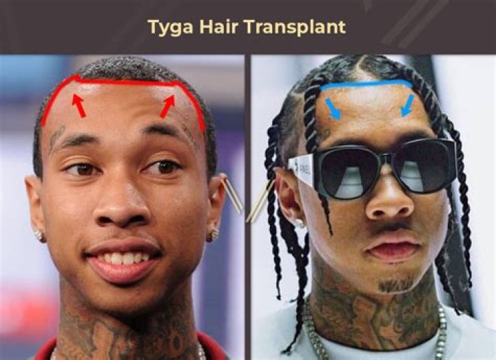 Nicki Minaj Spills Tea On Tyga’s Hair Transplant On Twitter — Tweet – Hollywood Life