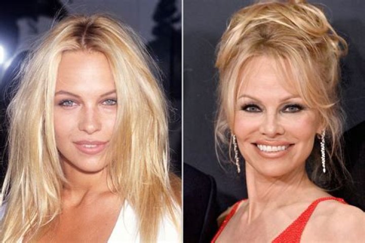 Pamela Anderson Looks Super Young — Expert Weighs In On If She Got Plastic Surgery